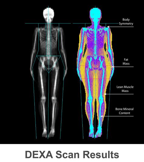 bone density test machine|bone density scan example.